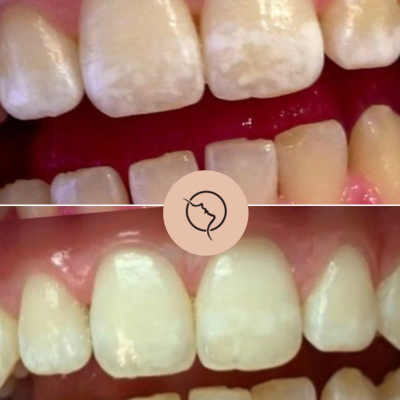 Beige Minimalist Beauty Before After Collage Instagram Post (1)